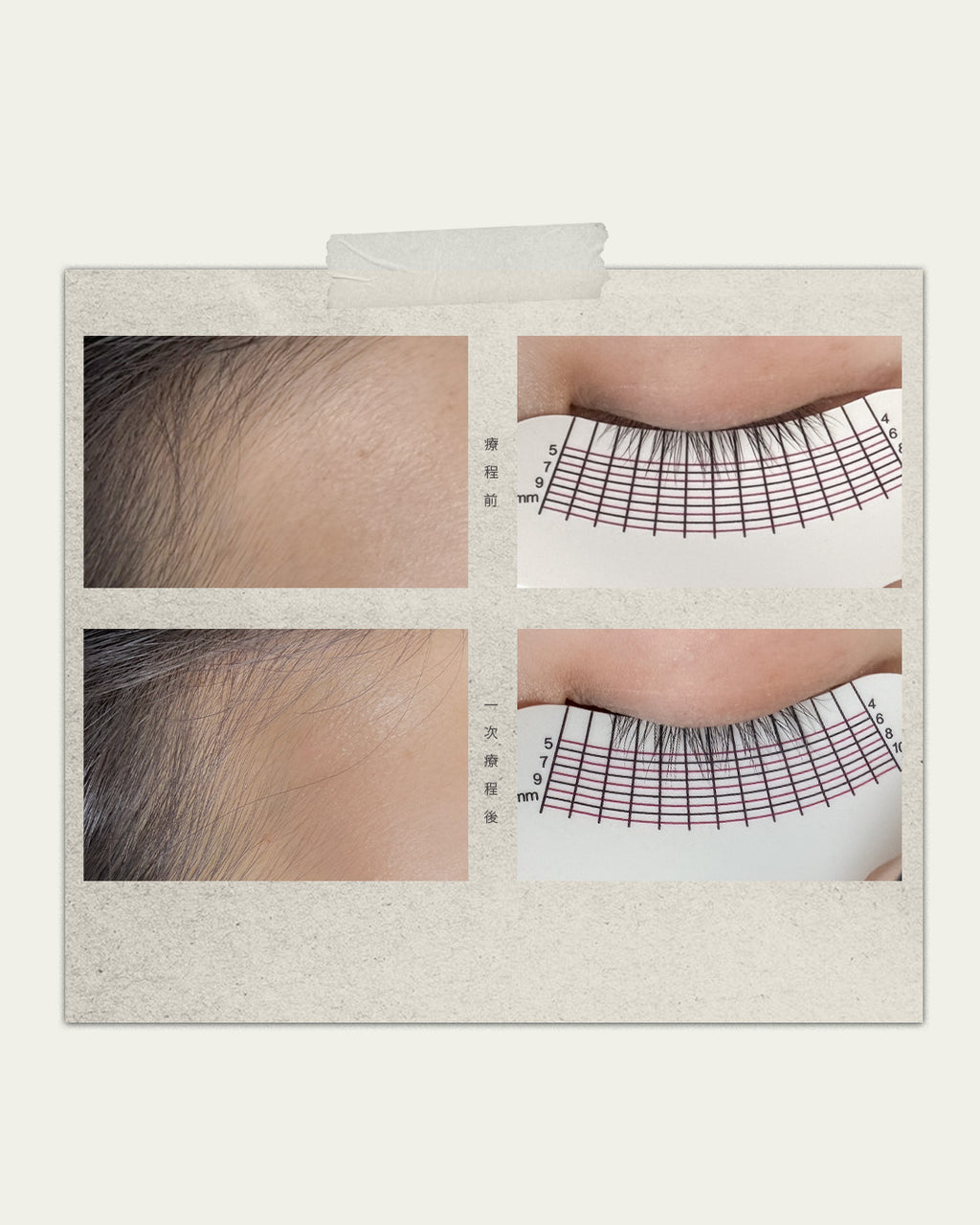 Lash Regrowth 開毛囊孕睫術