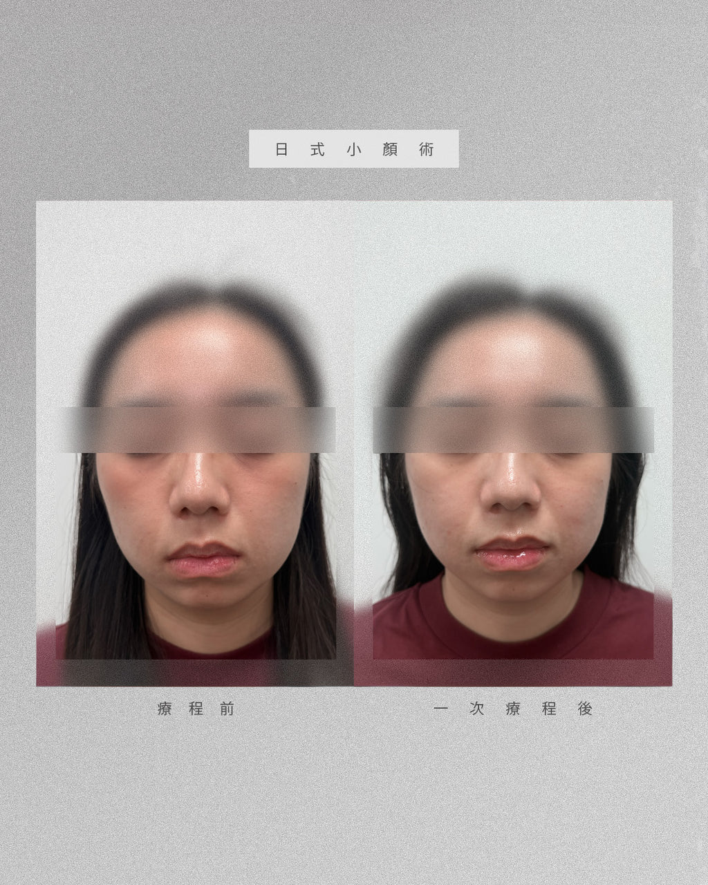 日式小顏術